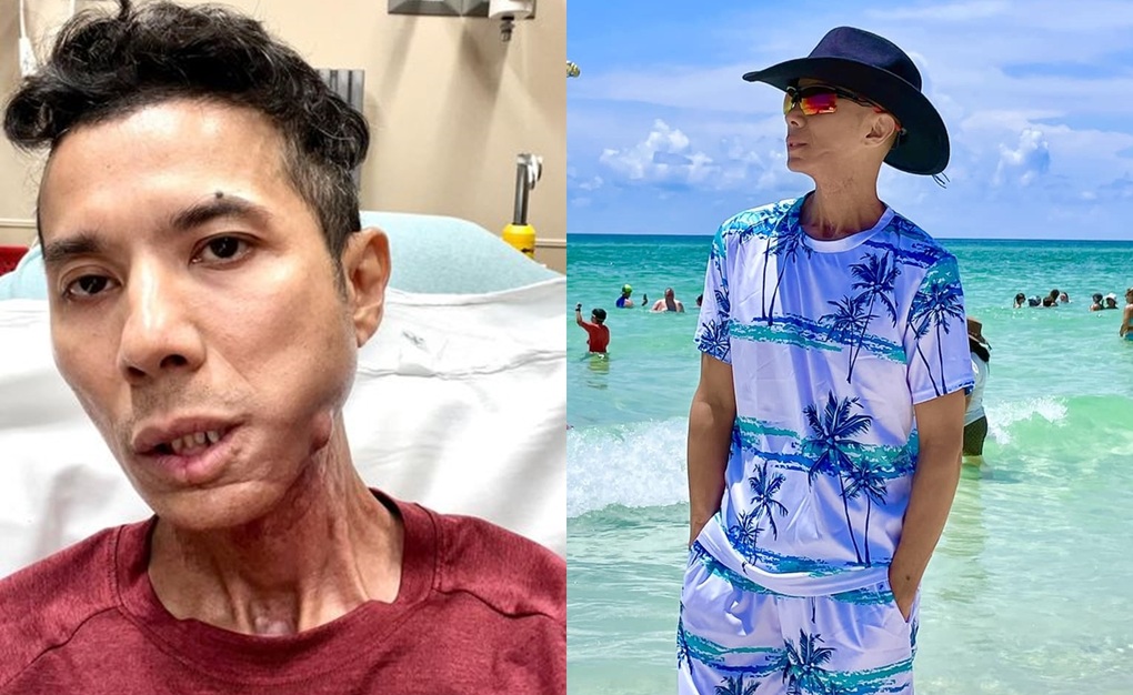 Kasim Hoàng Vũ sau 5 ngày cấp cứu: Không thể ăn, uống giảm đau mỗi ngày - 1 Kasim Hoàng Vũ sau 5 ngày cấp cứu: Không thể ăn, uống giảm đau mỗi ngày - 1