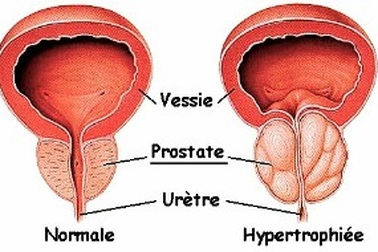 Phì đại tuyến tiền liệt có đáng sợ?