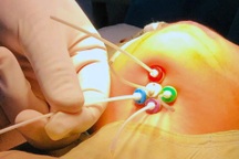 BV Ung bướu TPHCM dẫn phóng xạ liều cao điều trị ung thư lưỡi cho bé 3 tuổi