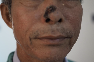 Căn bệnh ung thư diễn tiến thầm lặng, thường gặp nhất ở người cao tuổi