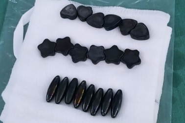 Nuốt 20 viên nam châm vì tưởng kẹo, bé trai phải cắt bỏ 15cm ruột