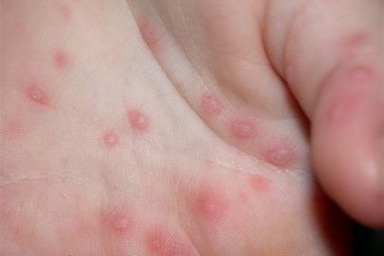 Bệnh tay chân miệng: Chủ yếu điều trị tại nhà