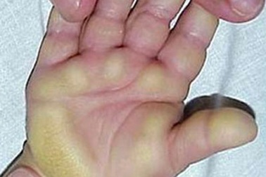 “Bệnh da lạ” Quảng Ngãi: Không xuất hiện thêm ca bệnh mới!