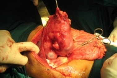 Phẫu thuật thành công khối u gan nặng 1kg  
