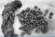 Túi mật "hóa đá" vì tự ý điều trị đau dạ dày