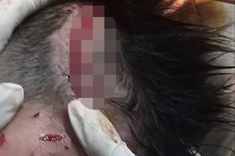 Bé trai 4 tuổi chơi trước sân bị chó nhà cắn lóc 13cm da đầu