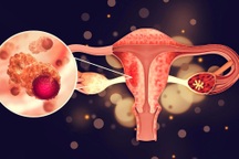 Chứng rối loạn phổ biến ở phụ nữ có thể dẫn đến ung thư buồng trứng