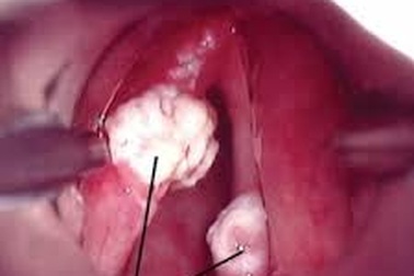 Ung thư thanh quản