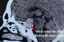 Chàng trai đột ngột mất thị lực vì khối u tuyến yên chảy máu