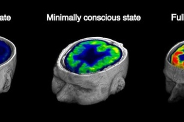 Dự đoán khả năng tỉnh lại của bệnh nhân bị hôn mê