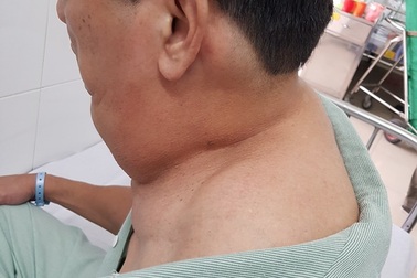 Uống 1 lít rượu mỗi ngày, người đàn ông phát hoảng vì chiếc cổ kỳ dị