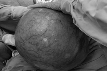 Người phụ nữ tưởng béo bụng, ngỡ ngàng phát hiện khối u nặng 10kg