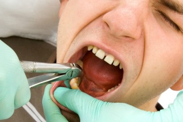 Ăn uống thế nào sau khi nhổ răng khôn?