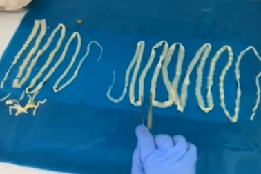 Cặp sán dây “khủng” trong cơ thể người đàn ông ngoại quốc