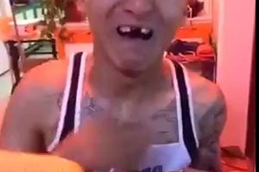 Gãy răng vì “đua đòi” ăn bắp bằng máy khoan