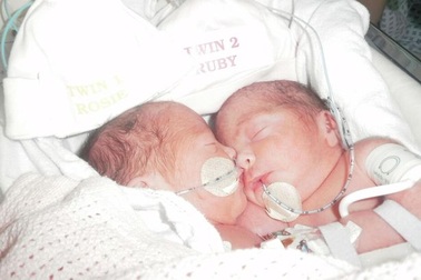 Phép màu đến với hai cô bé sinh đôi dính liền bụng