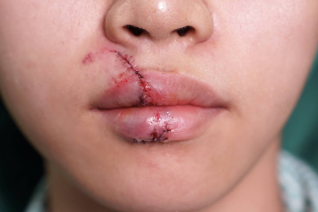 Đùa giỡn quá trớn với cún cưng, cô gái 18 tuổi ở TPHCM bị cắn rách môi - 2