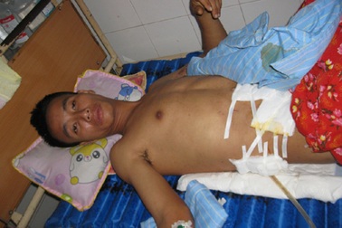 Cứu sống bệnh nhân bị càng xe bò đâm thủng bụng