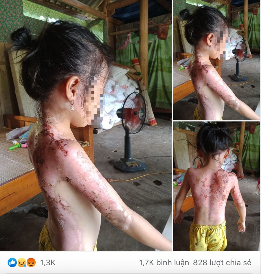 Bị hàng xóm hắt nước sôi, bé 7 tuổi bỏng nặng - 1 Bị hàng xóm hắt nước sôi, bé 7 tuổi bỏng nặng - 1