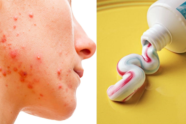 Mặt nữ sinh "nở hoa" vì dùng kem đánh răng chữa mụn theo Tiktok