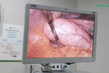 Người phụ nữ phải cắt bỏ túi mật vì "tích" hơn 500 viên sỏi