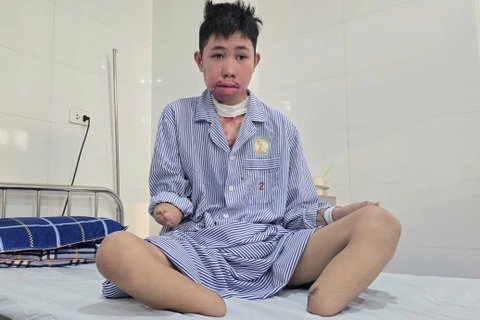 Nam sinh mất chân, tay vì điện giật: "Mỗi bữa ăn của con là một cuộc chiến"