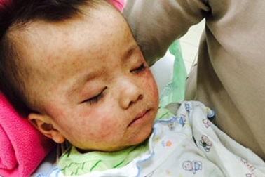 Gia tăng trẻ mắc sởi tại Hà Nội, 1 trẻ tử vong