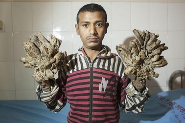 Căn bệnh kỳ lạ làm người hoá cây