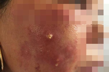 Hai mẹ con mặt mũi sưng vù, khó thở vì tiêm làm trắng da