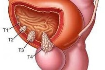 Thực hiện 6 hướng dẫn dưới đây để phòng chống ung thư bàng quang