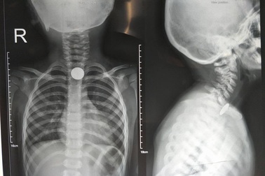 Chơi đồng xu, bé trai nuốt trôi tọt vào thực quản