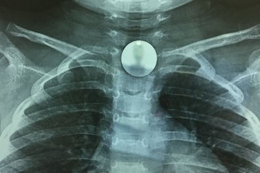 Bé gái ngậm đồng xu, trôi tọt vào họng khi đang chơi đùa