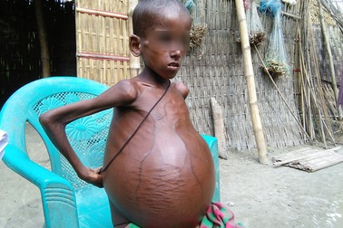 Con trai bị bạn nghịch khiến bụng phình to, cha lập tức đưa tới viện nhưng không kịp