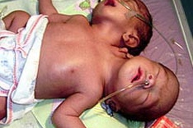 Em bé hai đầu tại Indonesia đã qua đời