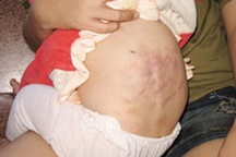 Bé gái 9 tháng tuổi bị bảo mẫu hành hạ