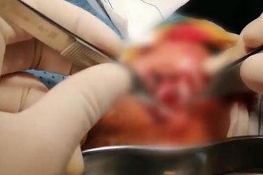 Bắt hơn 50 con giòi từ vết thương mưng mủ của cụ bà 97 tuổi