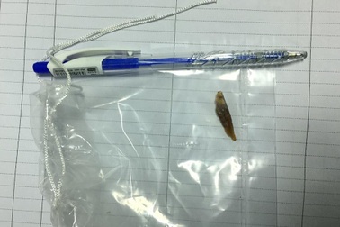 Bệnh nhân bị thủng ruột do nuốt mảnh xương heo