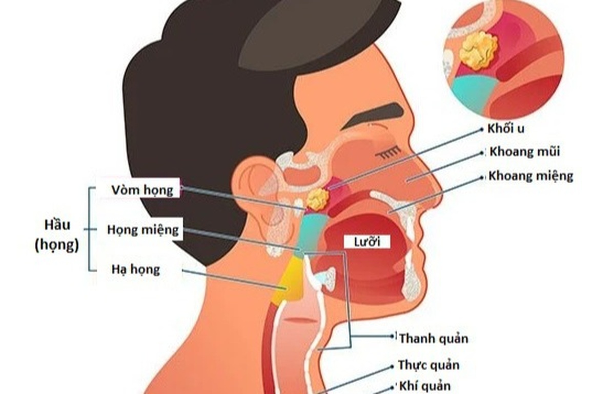 Triệu chứng của ung thư vòm họng là gì? - 1 Triệu chứng của ung thư vòm họng là gì? - 1