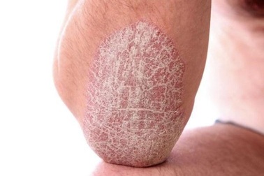 Bộ đôi sản phẩm Kim Miễn Khang và Explaq - Phương pháp độc đáo giúp cải  thiện vảy nến hiệu quả, an toàn