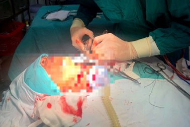 Cấp cứu kịp thời một trường hợp bị cắt sâu vùng cổ, đứt khí quản