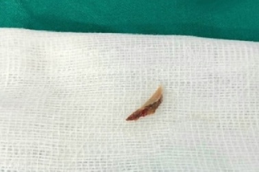 Mảnh xương gà bị “bỏ quên” trong phổi bé trai suốt 2 năm