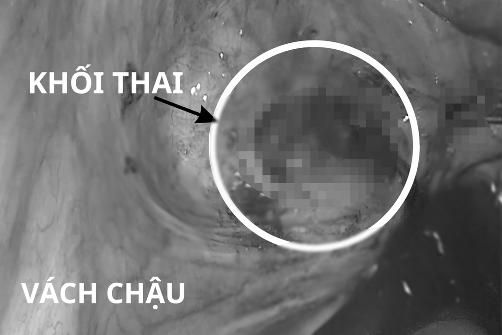 Người mẹ mang thai lạc chỗ cực hiếm dù đã đặt vòng, tỷ lệ tử vong rất cao - 1