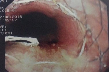 Hóc đồ chơi, bé 6 tuổi bị thủng thực quản 2 năm không biết