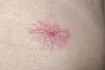 3 biến đổi trên da cảnh báo bệnh ung thư gan