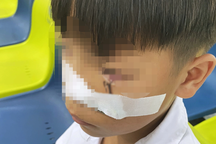 Cấp cứu bé trai 11 tuổi bị lưỡi câu sắc nhọn móc vào mắt khi đùa giỡn