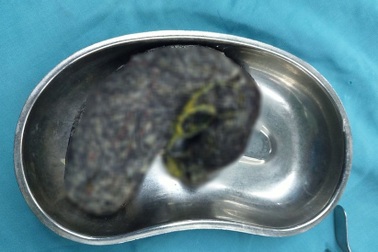 Giật mình phát hiện cả khối tóc đen sì, nặng 5 lạng trong dạ dày bé 7 tuổi