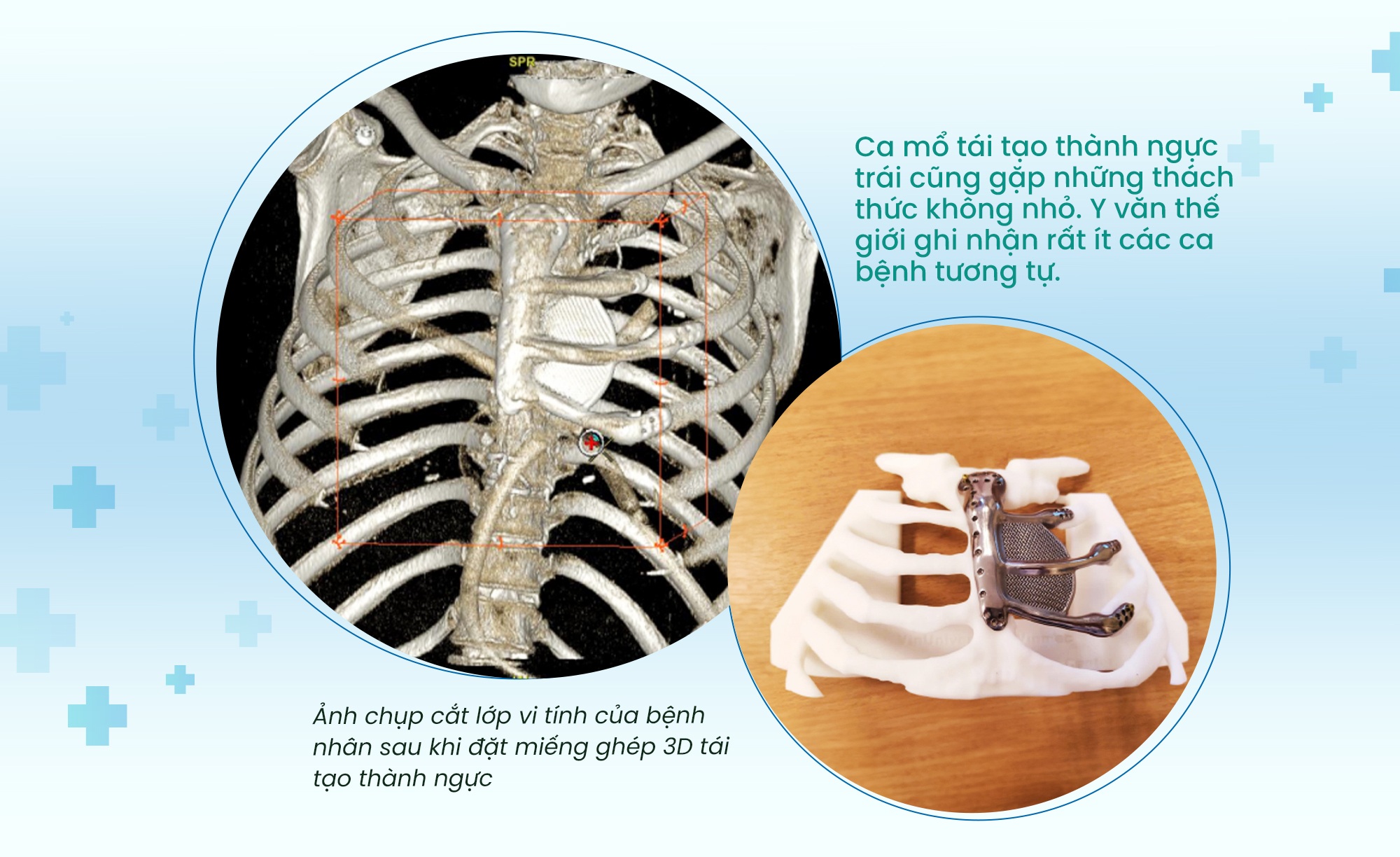 Phẫu thuật tái tạo lồng ngực ứng dụng công nghệ 3D - bước tiến của y học - 5 Phẫu thuật tái tạo lồng ngực ứng dụng công nghệ 3D - bước tiến của y học - 5