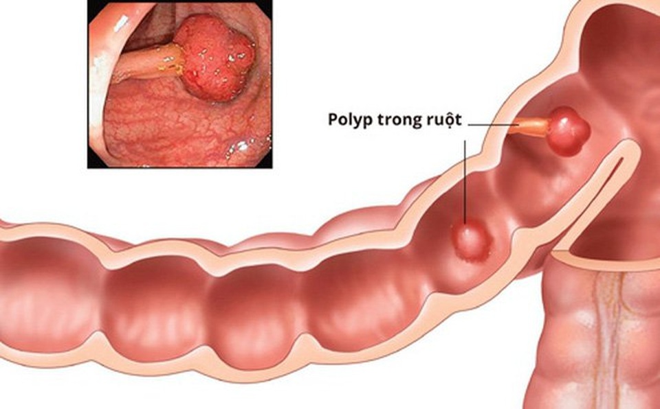 Lằn ranh mỏng manh giữa bệnh polyp đại tràng và ung thư - 1 Lằn ranh mỏng manh giữa bệnh polyp đại tràng và ung thư - 1