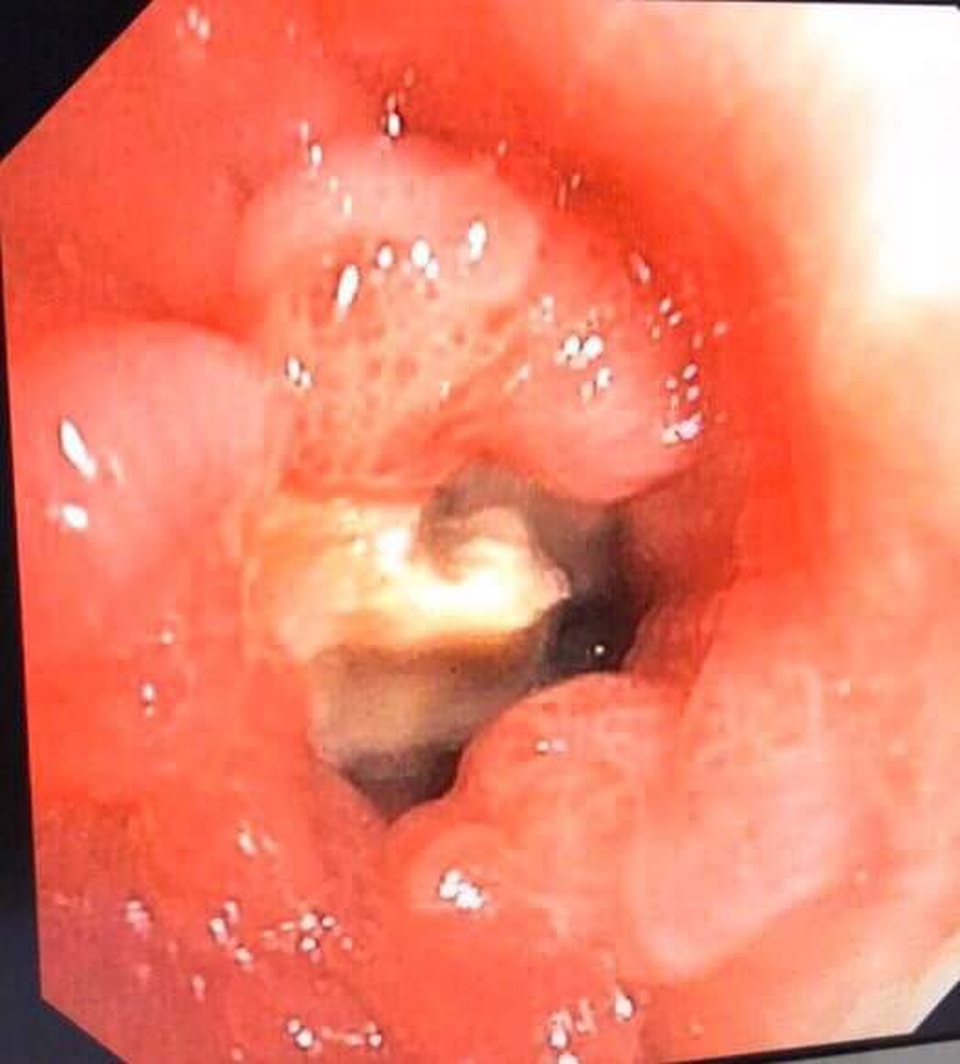 Hy hữu bệnh nhân mắc xương cá 5 năm không biết - 1
