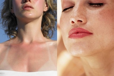 5 giải pháp cho làn da mùa nắng ‘thiêu đốt’